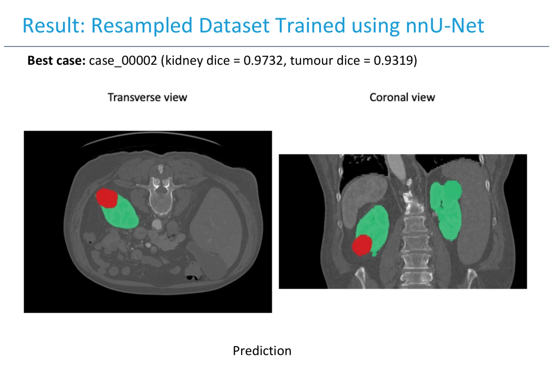 Segmentation Of CT Scans Using CNN